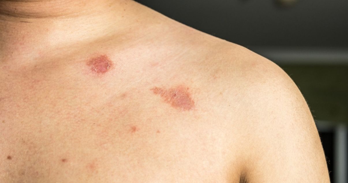 how contagious is ringworm